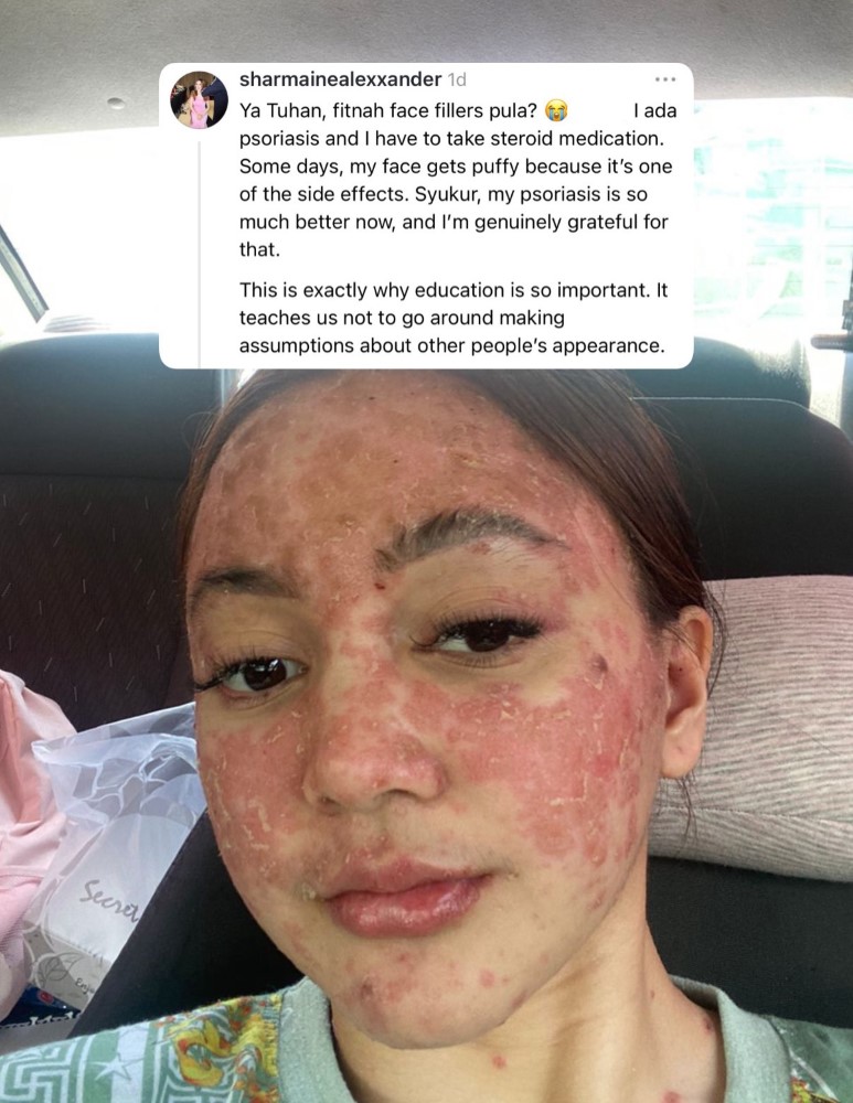 Wajah bengkak akibat psoriasis, Sharmaine Alexander bidas dakwaan suntik filler | MissMynah Wajah bengkak akibat psoriasis, Sharmaine Alexander bidas dakwaan suntik filler, pelakon, psoriasis, selebriti, Sharmaine Alexander, MissMynah